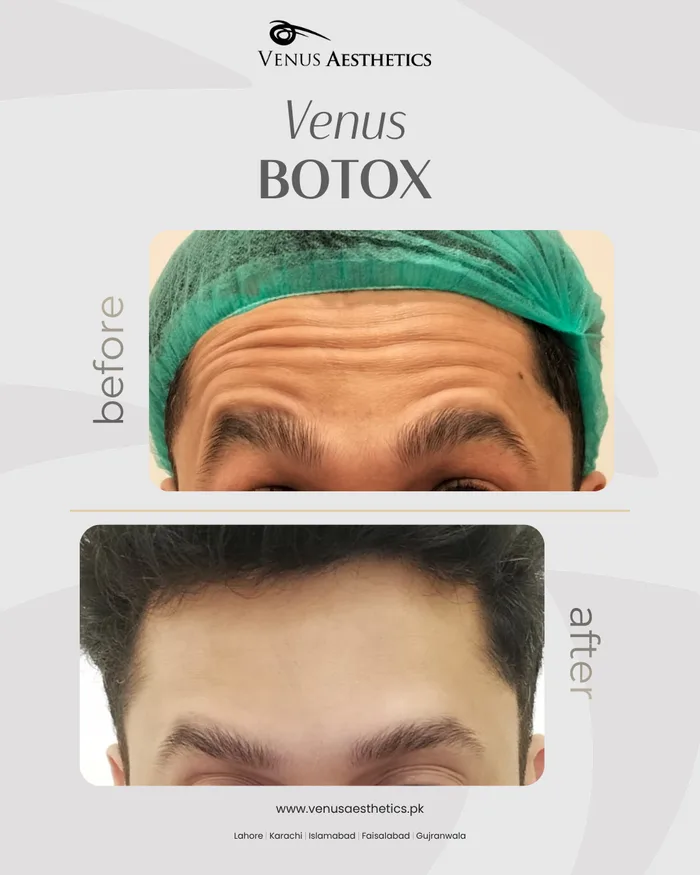 Botox treatment before and after photo of an actual Luxeria Clinic client, 1 of 2