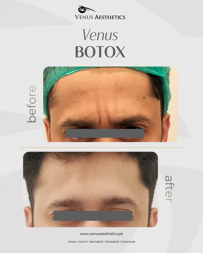Botox treatment before and after photo of an actual Luxeria Clinic client, 2 of 2