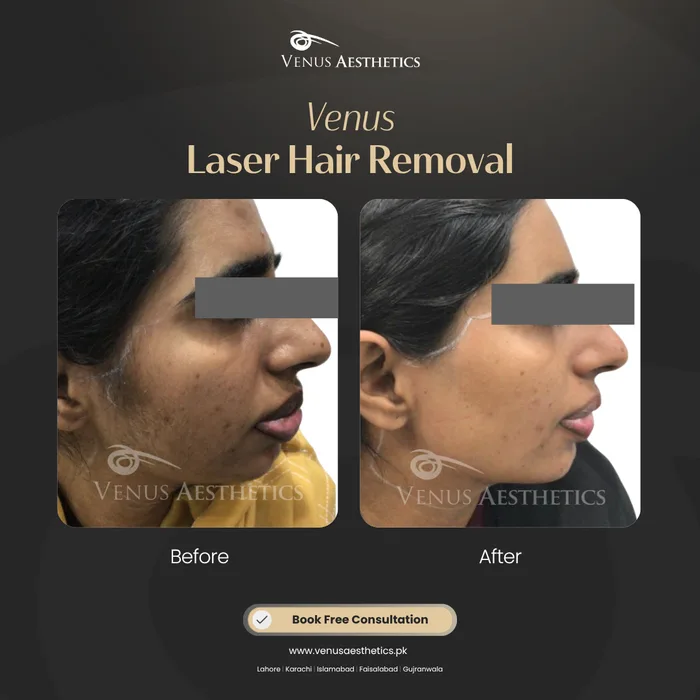 Laser hair removal before and after photo of an actual Luxeria Clinic client, 17 of 17