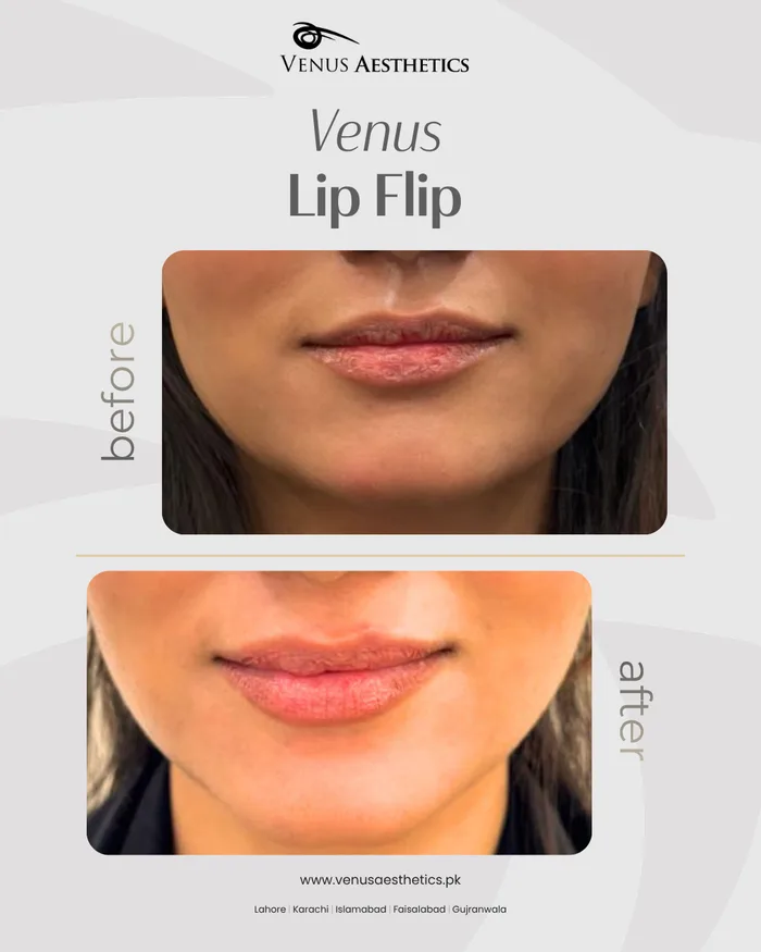 Botox lip flip before and after photo of an actual Luxeria Clinic client, 1 of 1