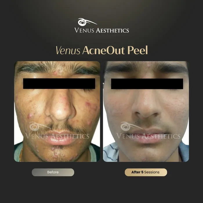 AcneOUT peel before and after result at Luxeria Clinic