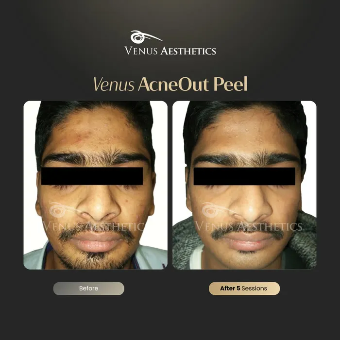 AcneOUT peel before and after result at Luxeria Clinic