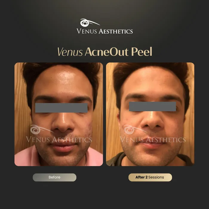 AcneOUT peel before and after result at Luxeria Clinic