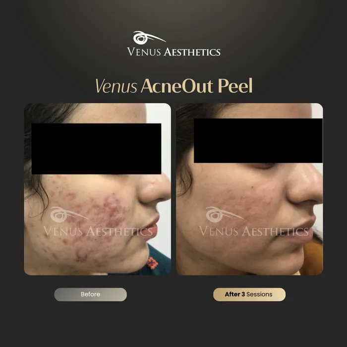 AcneOUT peel before and after result at Luxeria Clinic