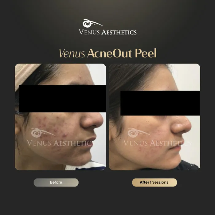 AcneOUT peel before and after result at Luxeria Clinic