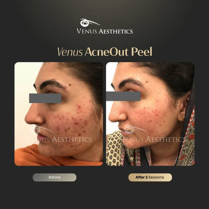 AcneOUT peel before and after result at Luxeria Clinic