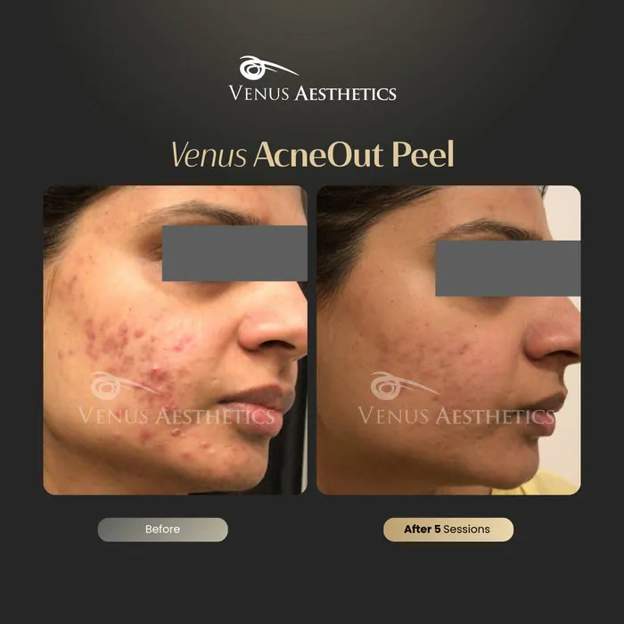 AcneOUT peel before and after result at Luxeria Clinic