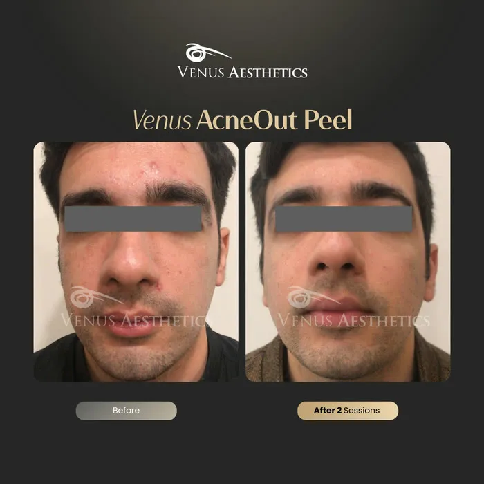 AcneOUT Peel for acne-prone skin before and after photo of an actual Luxeria Clinic client, 8 of 9