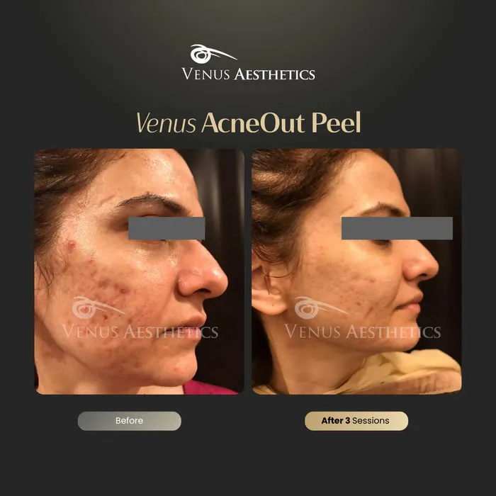 AcneOUT peel before and after result at Luxeria Clinic