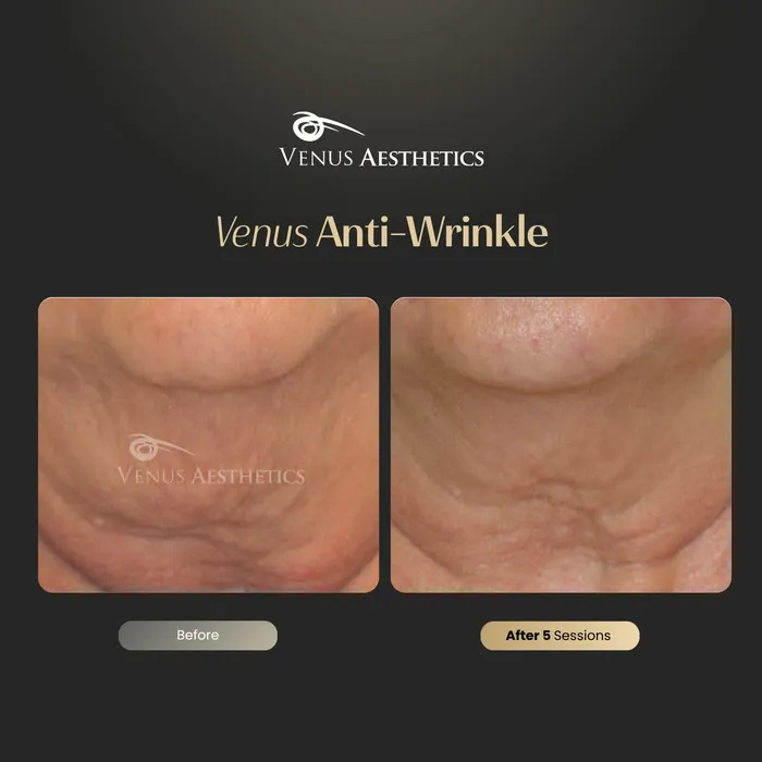 Anti-wrinkle before and after result at Luxeria Clinic
