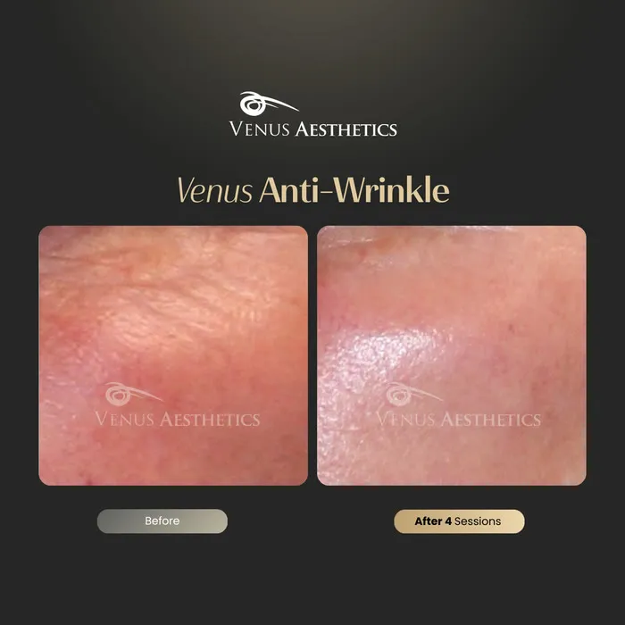 Anti-wrinkle before and after result at Luxeria Clinic