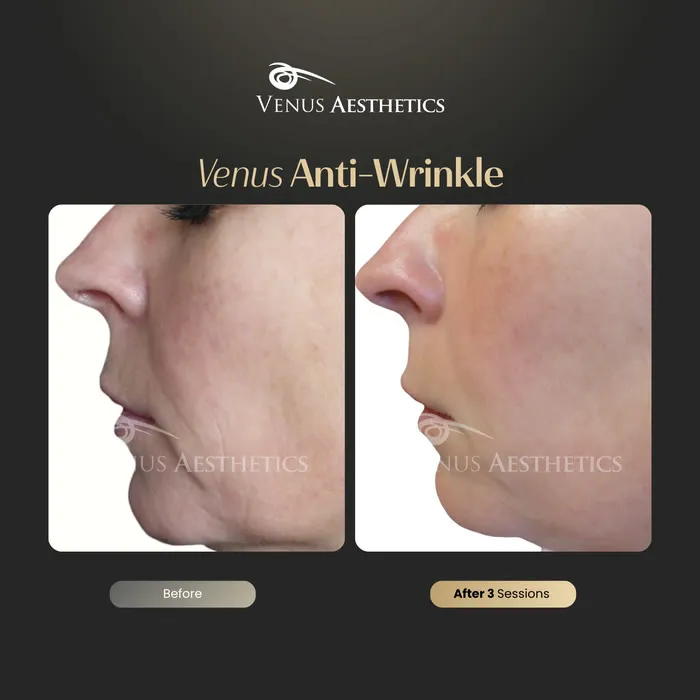 Anti-wrinkle before and after result at Luxeria Clinic