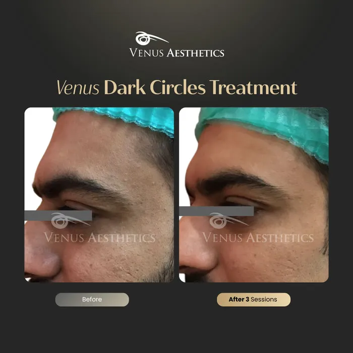 Dark circle treatment under the eyes before and after photo of an actual Luxeria Clinic client, 1 of 4