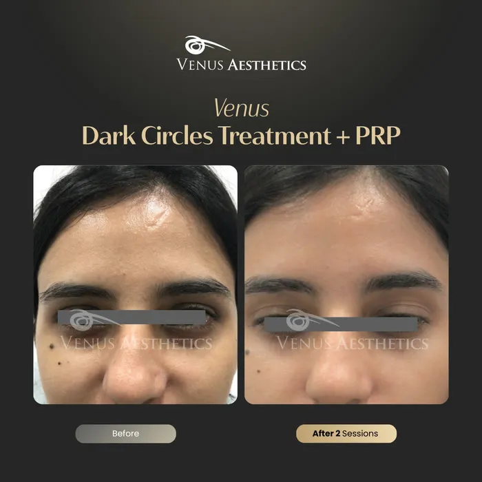 Dark circle treatment under the eyes before and after photo of an actual Luxeria Clinic client, 2 of 4
