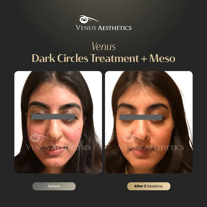 Dark circle treatment before and after result at Luxeria Clinic