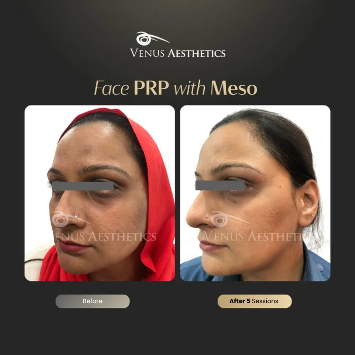 Dark circle treatment under the eyes before and after photo of an actual Luxeria Clinic client, 4 of 4
