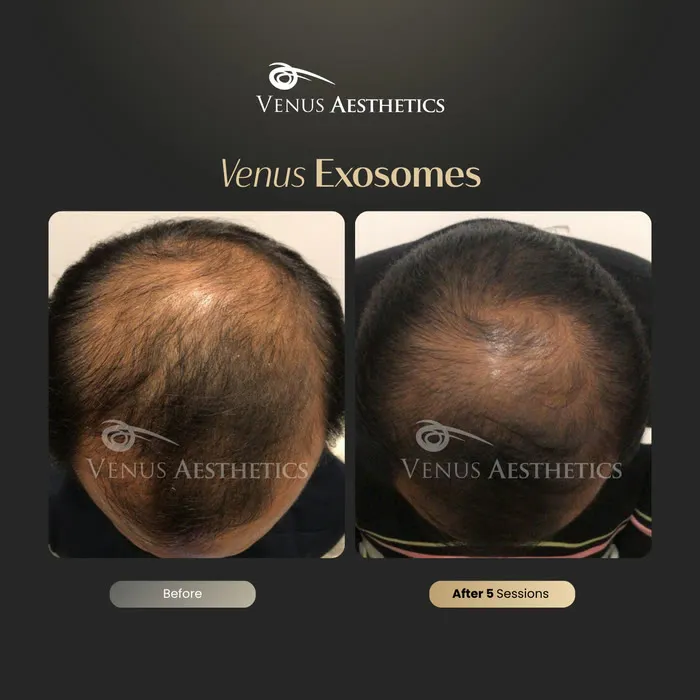 Exosome hair therapy before and after result at Luxeria Clinic