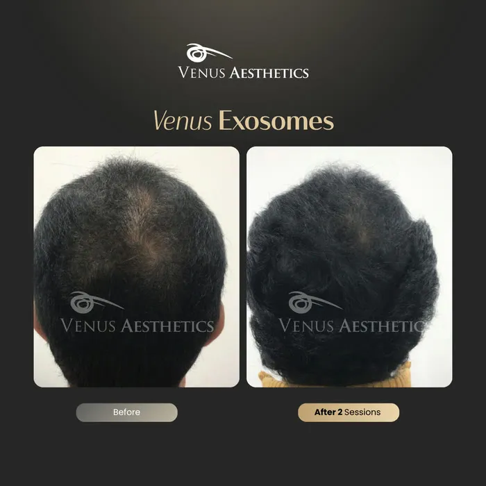 Exosome hair therapy before and after result at Luxeria Clinic