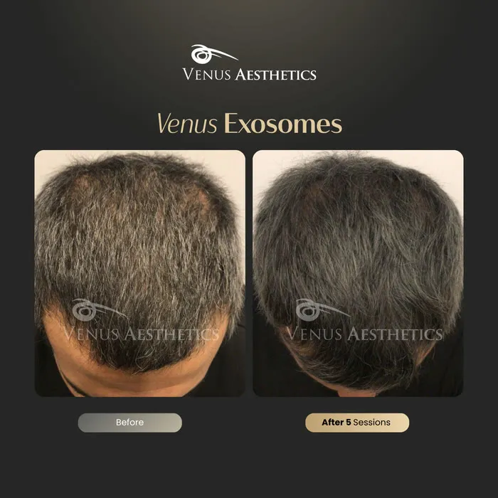 Exosome hair therapy before and after result at Luxeria Clinic