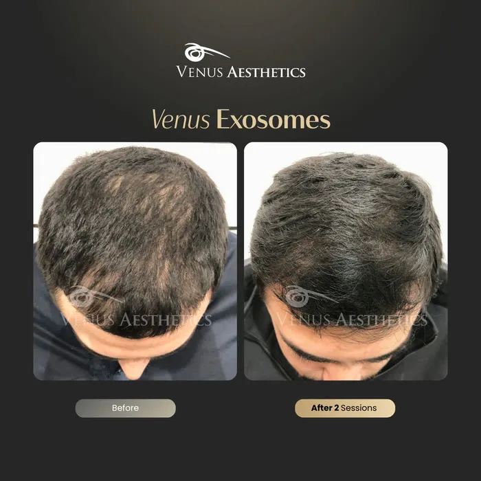 Exosome hair therapy before and after result at Luxeria Clinic