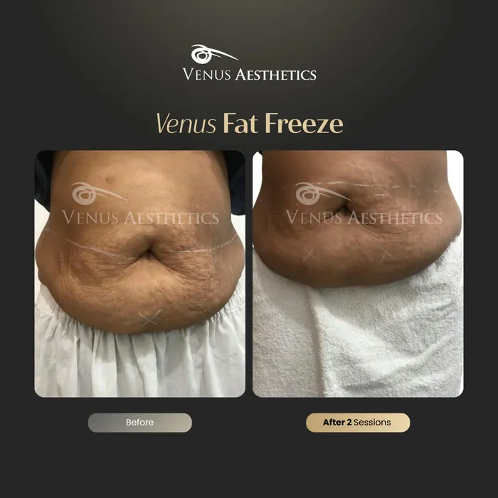 luxeria FatFree before and after result at Luxeria Clinic