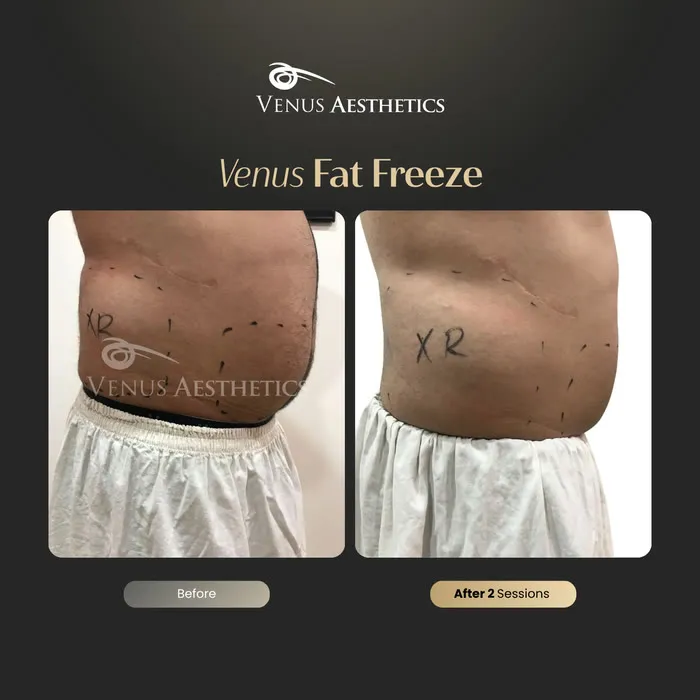 luxeria FatFree before and after result at Luxeria Clinic