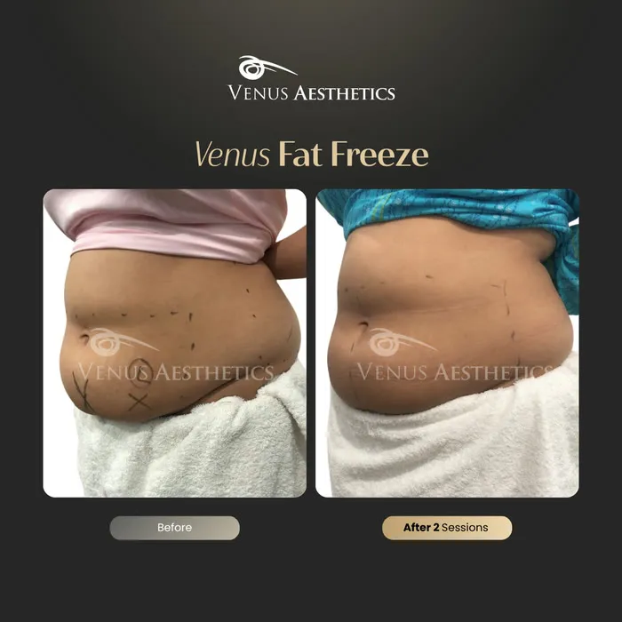 Fat freezing body contouring before and after photo of an actual Luxeria Clinic client, 3 of 8