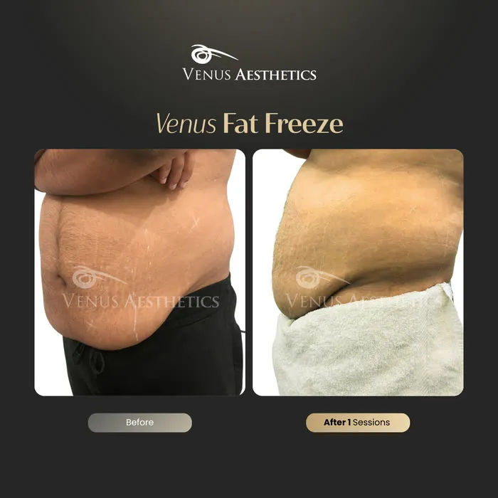 Fat freezing body contouring before and after photo of an actual Luxeria Clinic client, 4 of 8