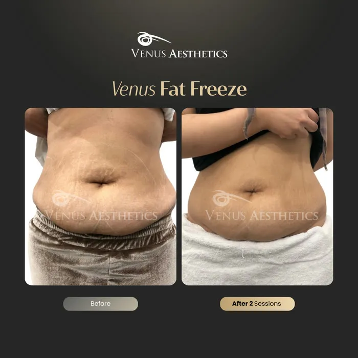 luxeria FatFree before and after result at Luxeria Clinic