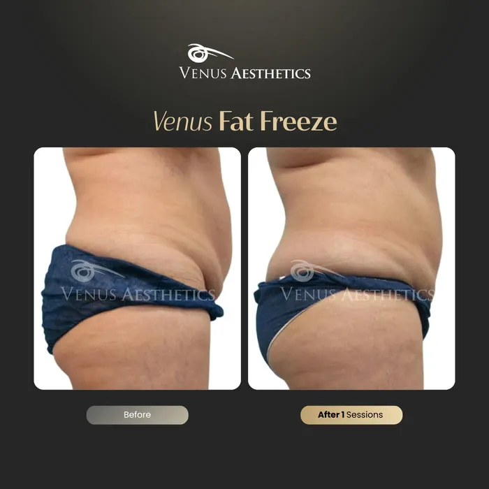 luxeria FatFree before and after result at Luxeria Clinic