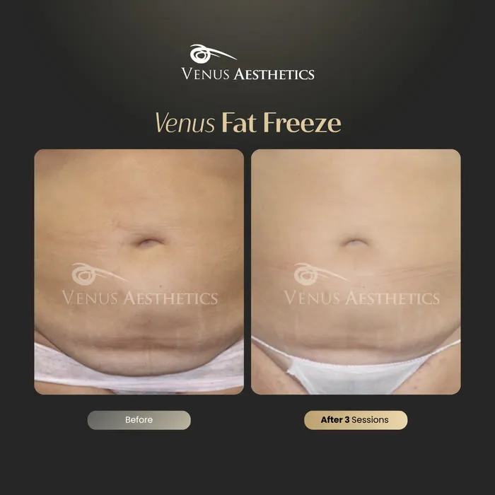 luxeria FatFree before and after result at Luxeria Clinic