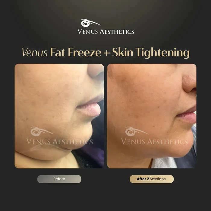 luxeria FatFree before and after result at Luxeria Clinic