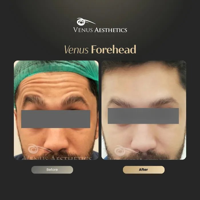 Forehead line Botox before and after result at Luxeria Clinic