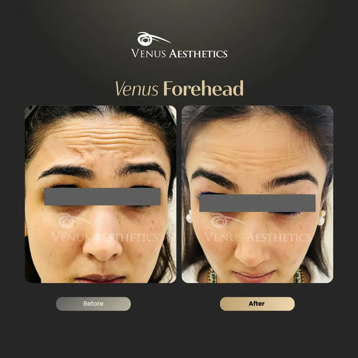 Forehead line Botox before and after result at Luxeria Clinic