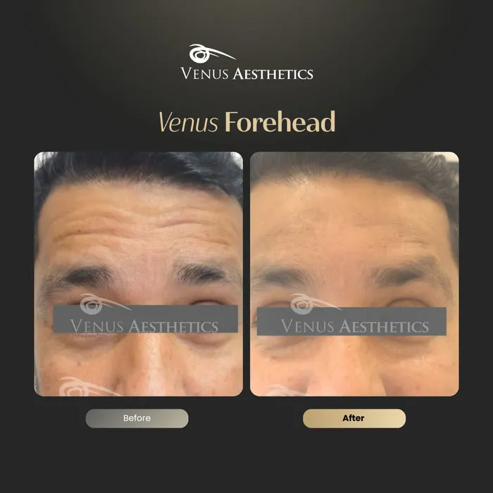 Forehead line Botox before and after result at Luxeria Clinic