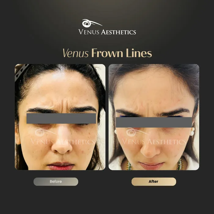 Botox for frown lines before and after photo of an actual Luxeria Clinic client, 4 of 7