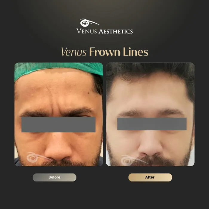 Botox for frown lines before and after photo of an actual Luxeria Clinic client, 5 of 7