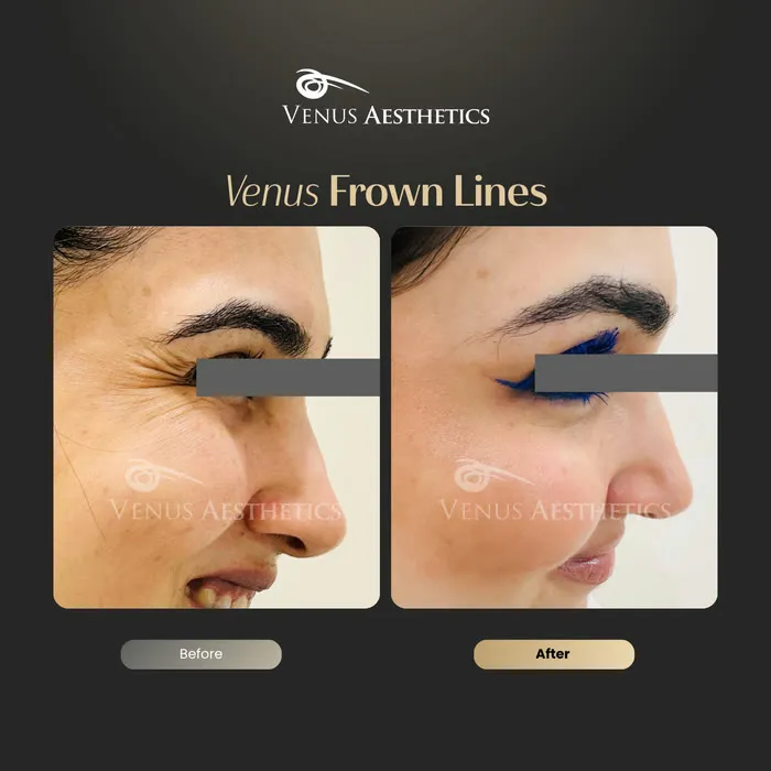Botox before and after result at Luxeria Clinic