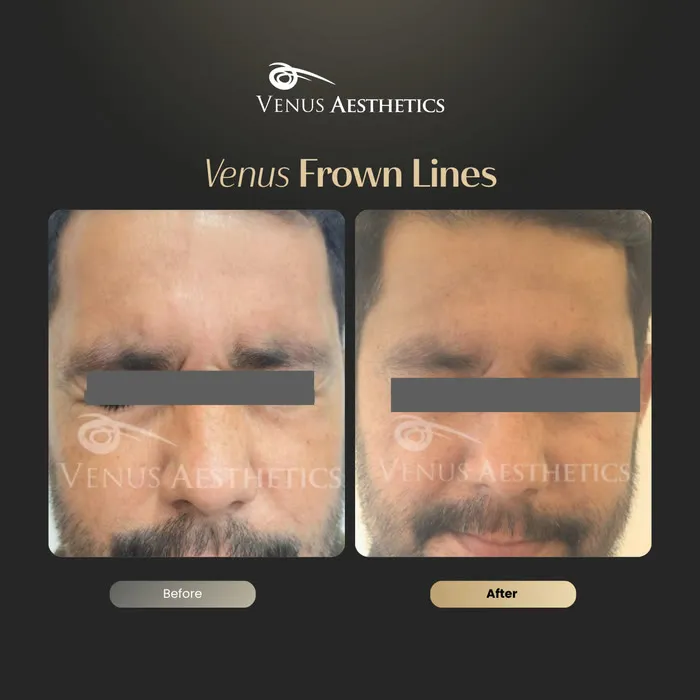 Botox before and after result at Luxeria Clinic