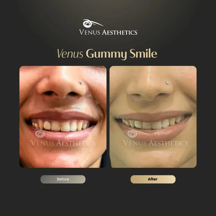 Gummy smile Botox before and after result at Luxeria Clinic