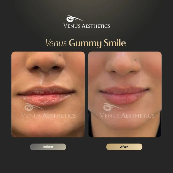 Gummy smile Botox before and after result at Luxeria Clinic