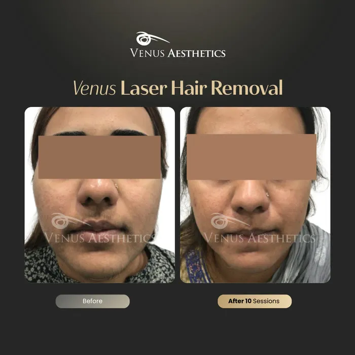 Laser hair removal before and after photo of an actual Luxeria Clinic client, 1 of 17