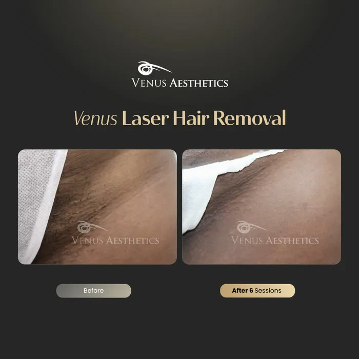 Laser hair removal before and after photo of an actual Luxeria Clinic client, 10 of 17