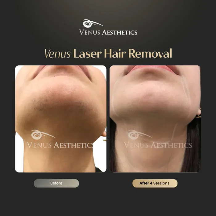 Laser hair removal before and after result at Luxeria Clinic