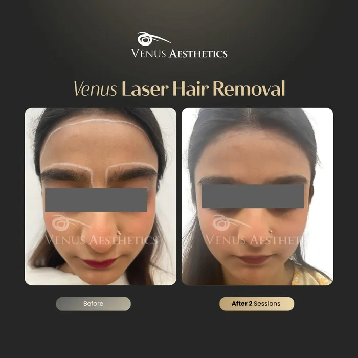 Laser hair removal before and after result at Luxeria Clinic