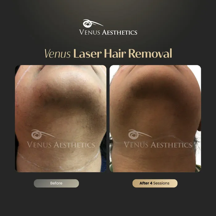 Laser hair removal before and after photo of an actual Luxeria Clinic client, 13 of 17