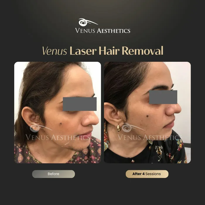 Laser hair removal before and after result at Luxeria Clinic