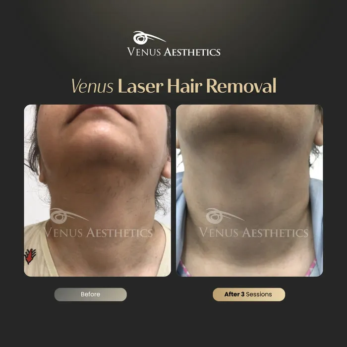 Laser hair removal before and after result at Luxeria Clinic