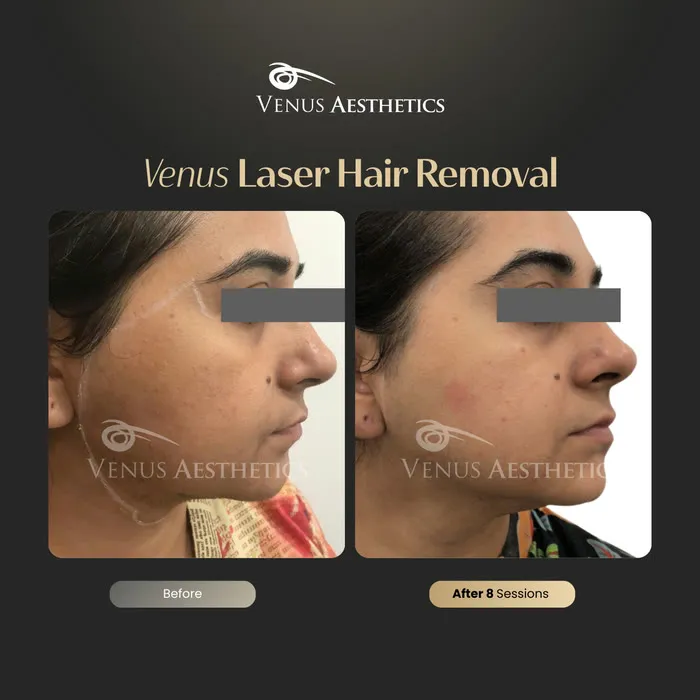 Laser hair removal before and after result at Luxeria Clinic