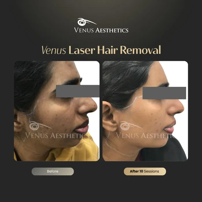 Laser hair removal before and after result at Luxeria Clinic